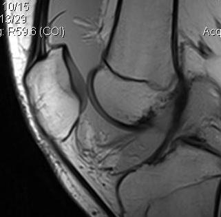 Lipoma Arborescens MRI Sagittal